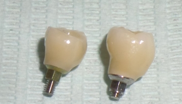 Denti in zirconia avvitati su impianti