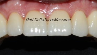 Full Arch in zirconia su denti naturali